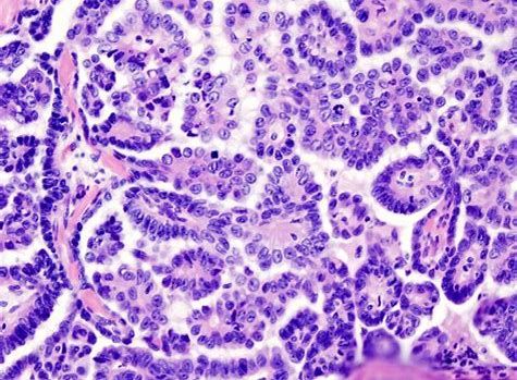 CancerRes：新钻研发现援手断根癌症干细胞的新靶标