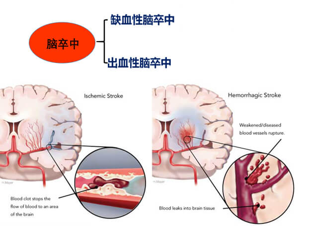 1-脑中风重要出缺血性中风和出血性脑卒中.jpg